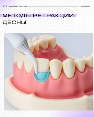 Ретракция десны: три метода, которые изменили тактику.